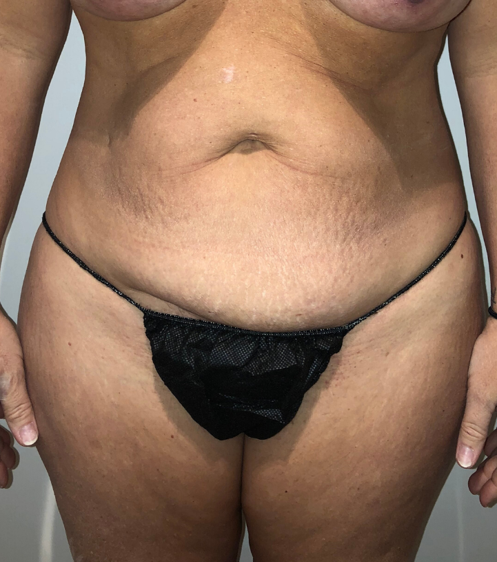 Before Image: Tummy Tuck - front