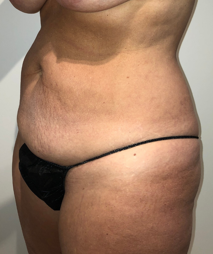 Before Image: Tummy Tuck - left-front-oblique