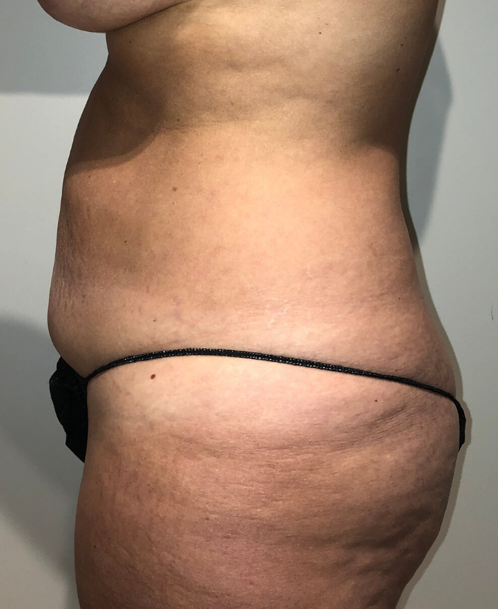 Before Image: Tummy Tuck - left-side