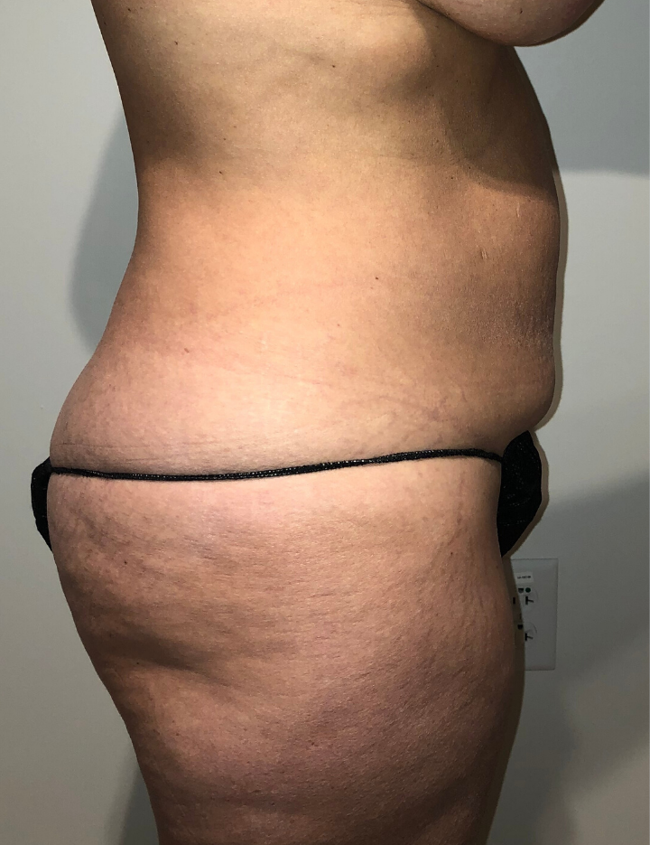 Before Image: Tummy Tuck - right-side