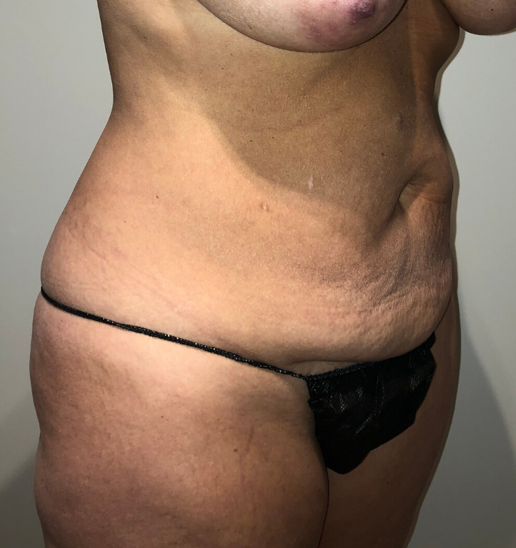 Before Image: Tummy Tuck - right-front-oblique