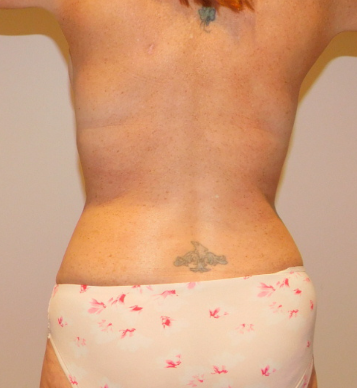 After Image: Mommy Makeover - back