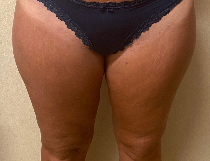 After Image: Standard Liposuction - front