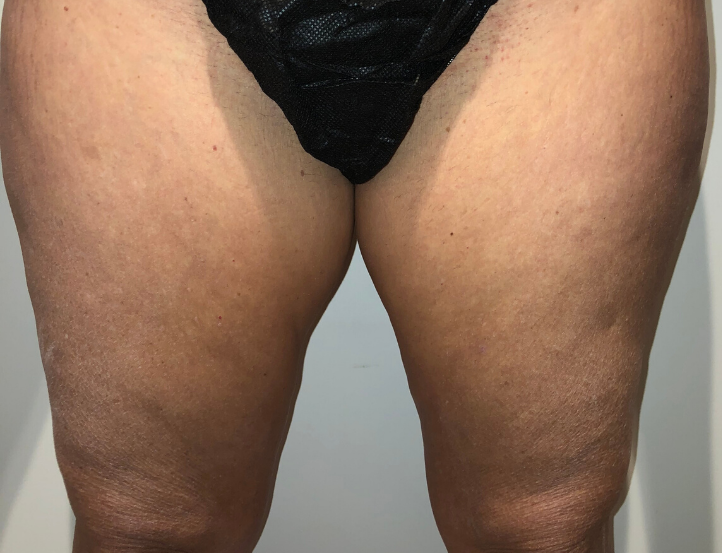 Before Image: Standard Liposuction - front