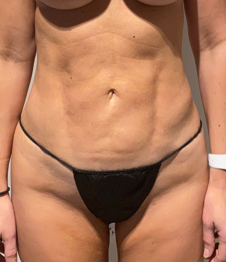 After Image: Standard Liposuction - front