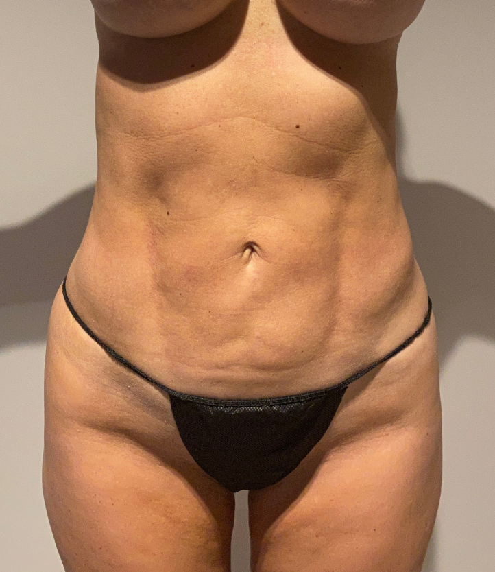 After Image: Standard Liposuction - front