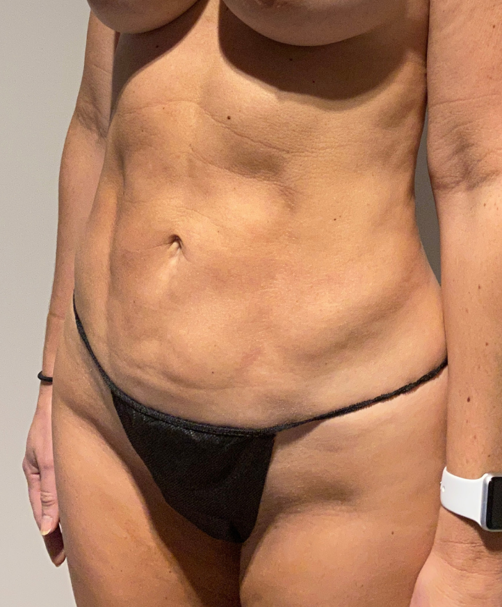After Image: Standard Liposuction - left-front-oblique