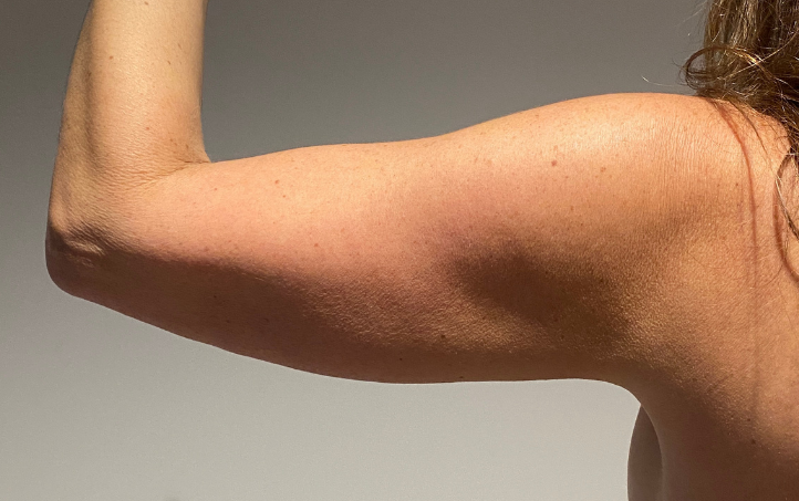 After Image: Standard Liposuction - back