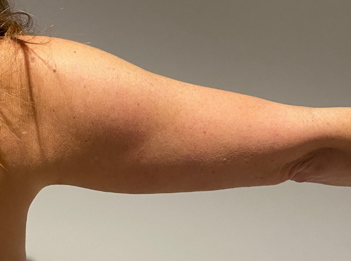 After Image: Standard Liposuction - back