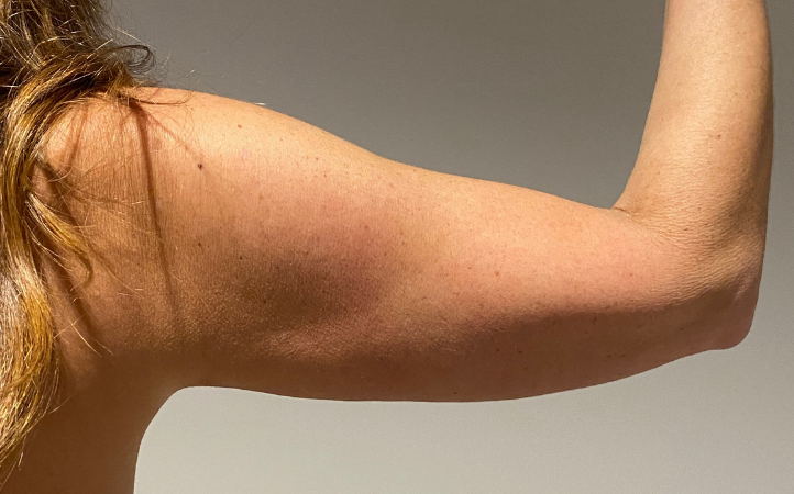 After Image: Standard Liposuction - back