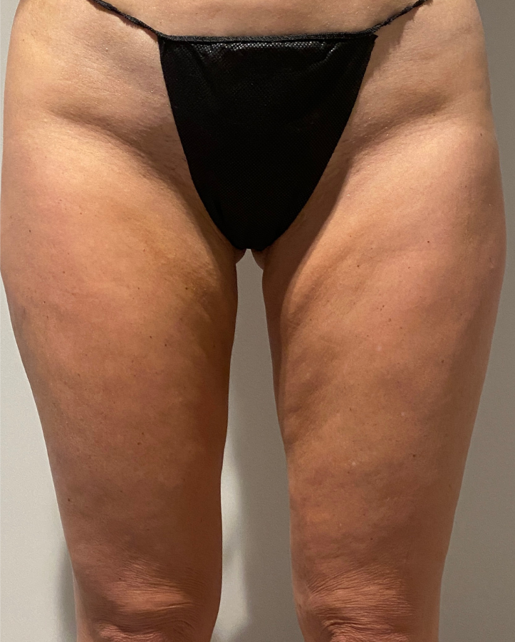 After Image: Standard Liposuction - front