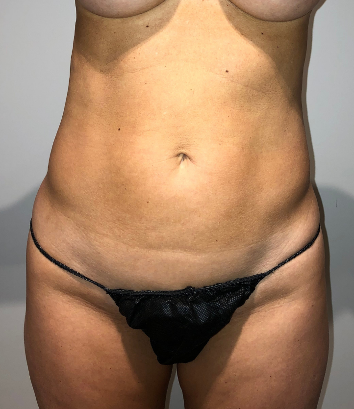 Before Image: Standard Liposuction - front