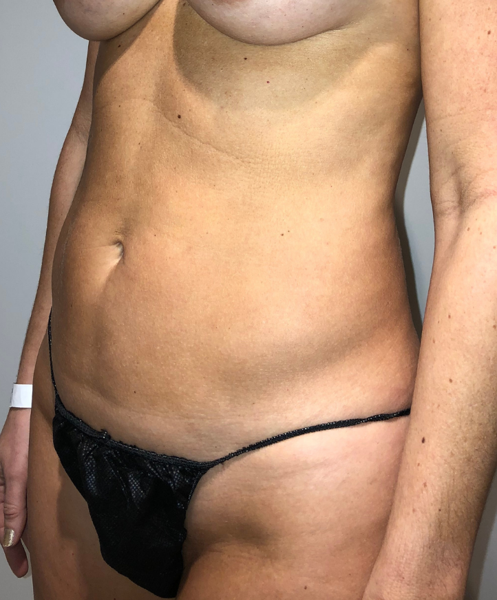 Before Image: Standard Liposuction - left-front-oblique