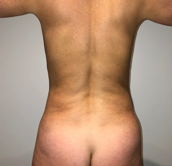 Before Image: Standard Liposuction - back
