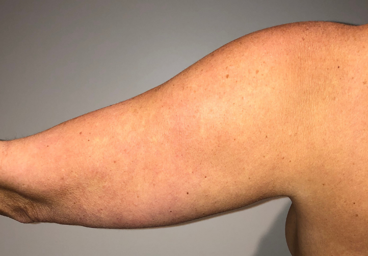 Before Image: Standard Liposuction - back