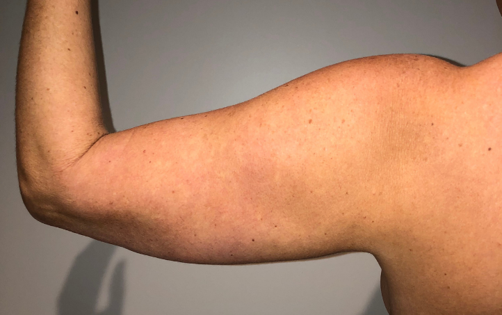 Before Image: Standard Liposuction - back
