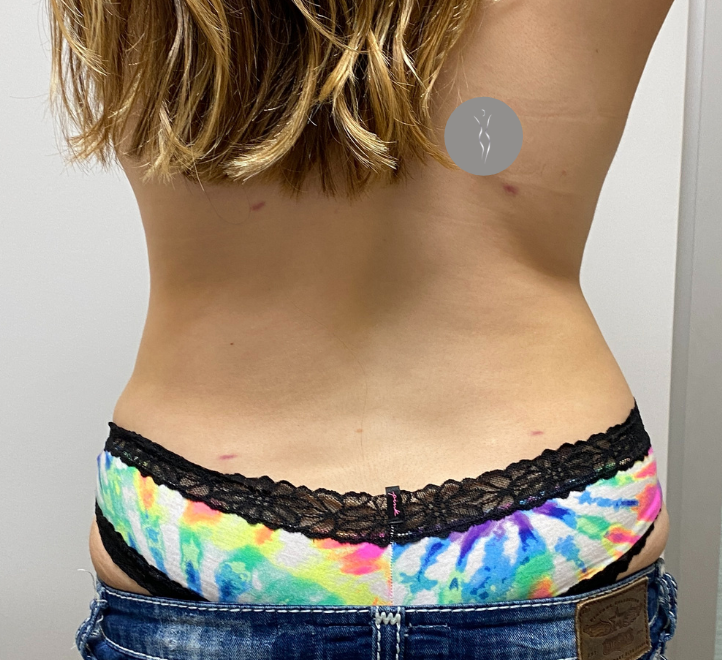 After Image: Tummy Tuck - back