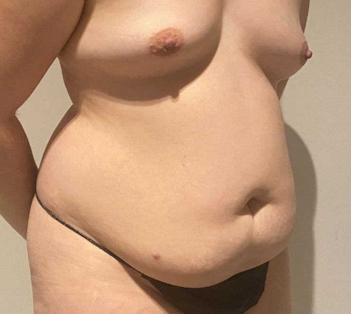 Before Image: Tummy Tuck - right-front-oblique