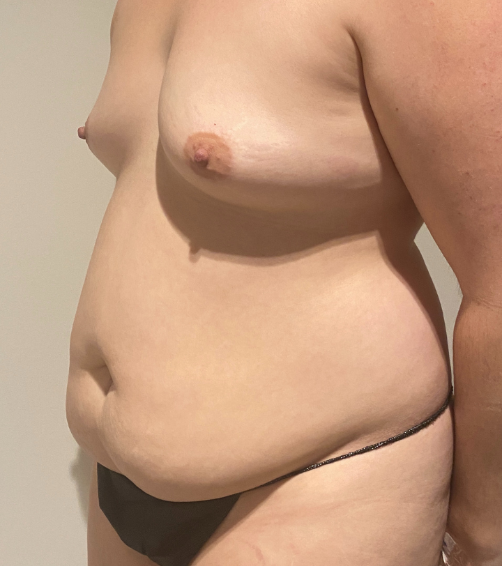 Before Image: Tummy Tuck - left-front-oblique