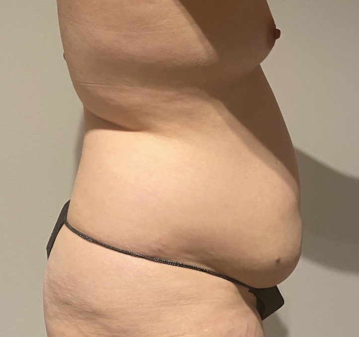 Before Image: Tummy Tuck - right-side
