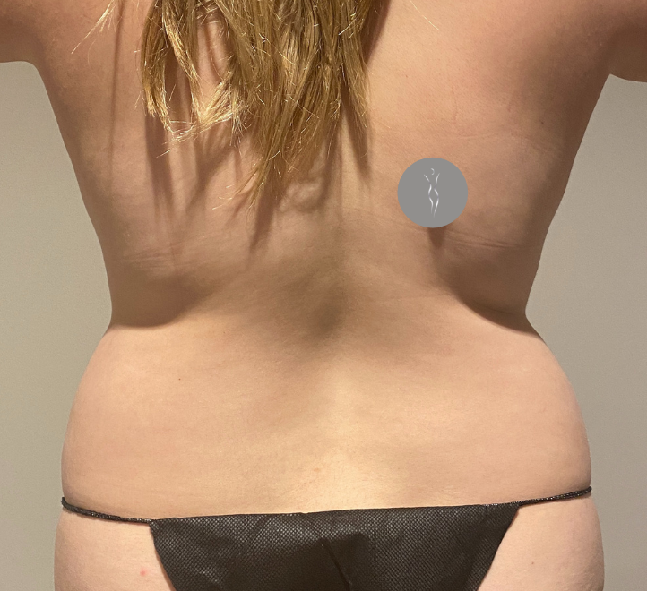 Before Image: Tummy Tuck - back