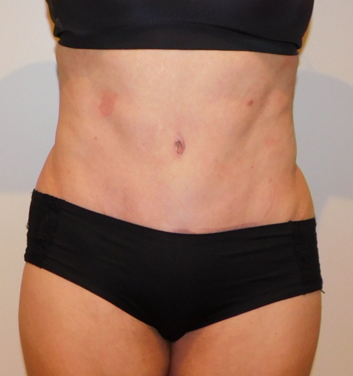 After Image: Tummy Tuck - front