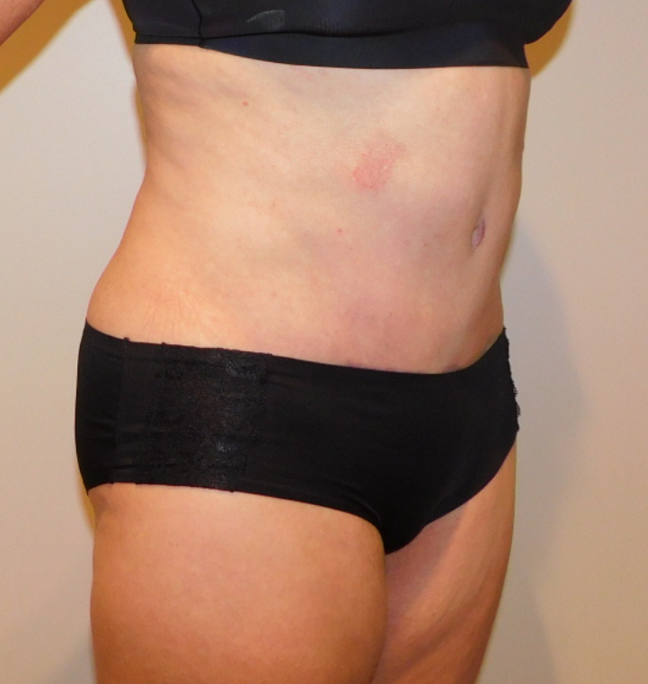 After Image: Tummy Tuck - right-front-oblique