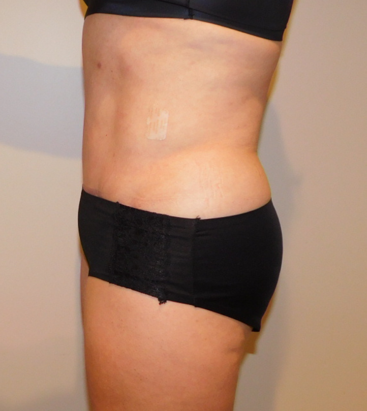 After Image: Tummy Tuck - left-side