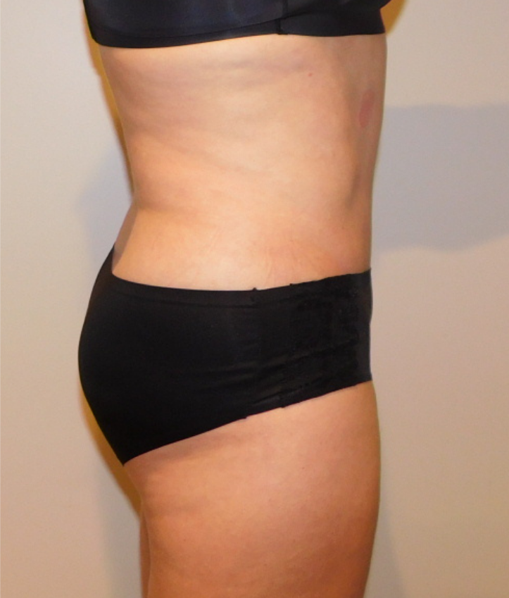 After Image: Tummy Tuck - right-side