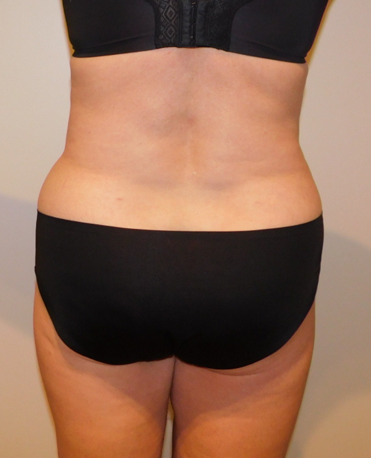 After Image: Tummy Tuck - back