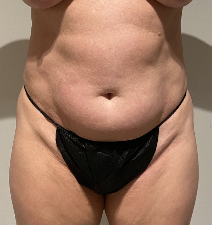 Before Image: Tummy Tuck - front