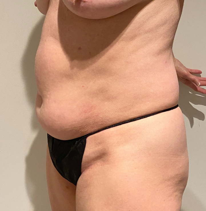 Before Image: Tummy Tuck - left-front-oblique