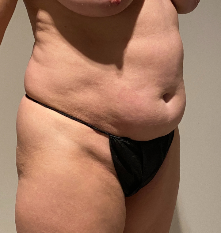 Before Image: Tummy Tuck - right-front-oblique