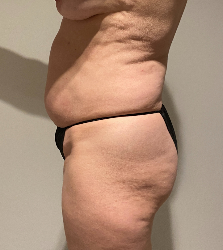 Before Image: Tummy Tuck - left-side