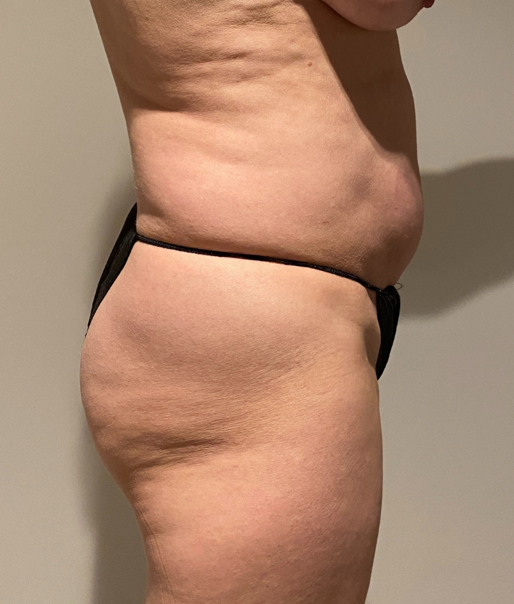 Before Image: Tummy Tuck - right-side