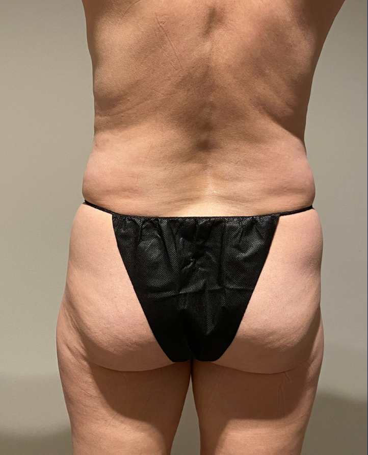 Before Image: Tummy Tuck - back