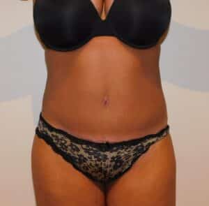 After Image: Tummy Tuck