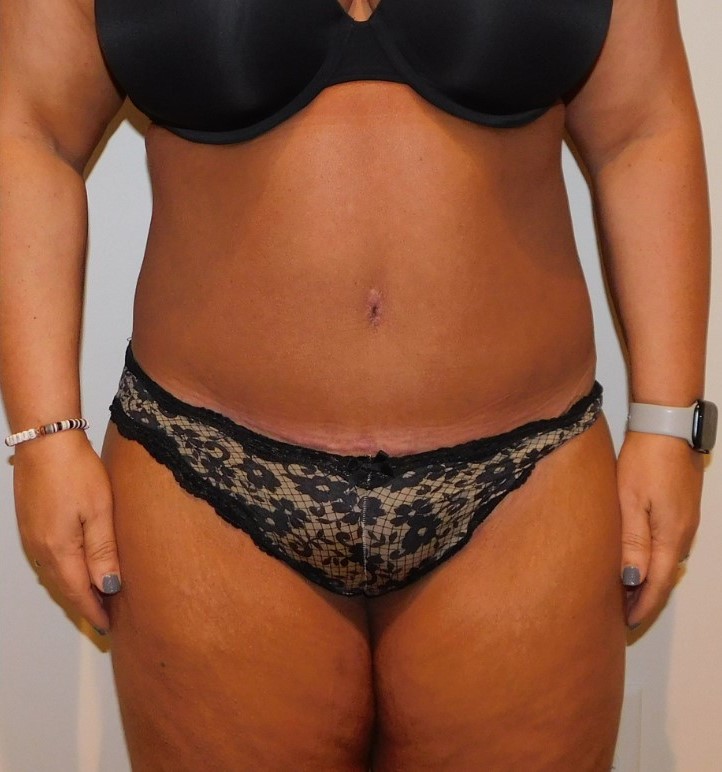 After Image: Tummy Tuck - front