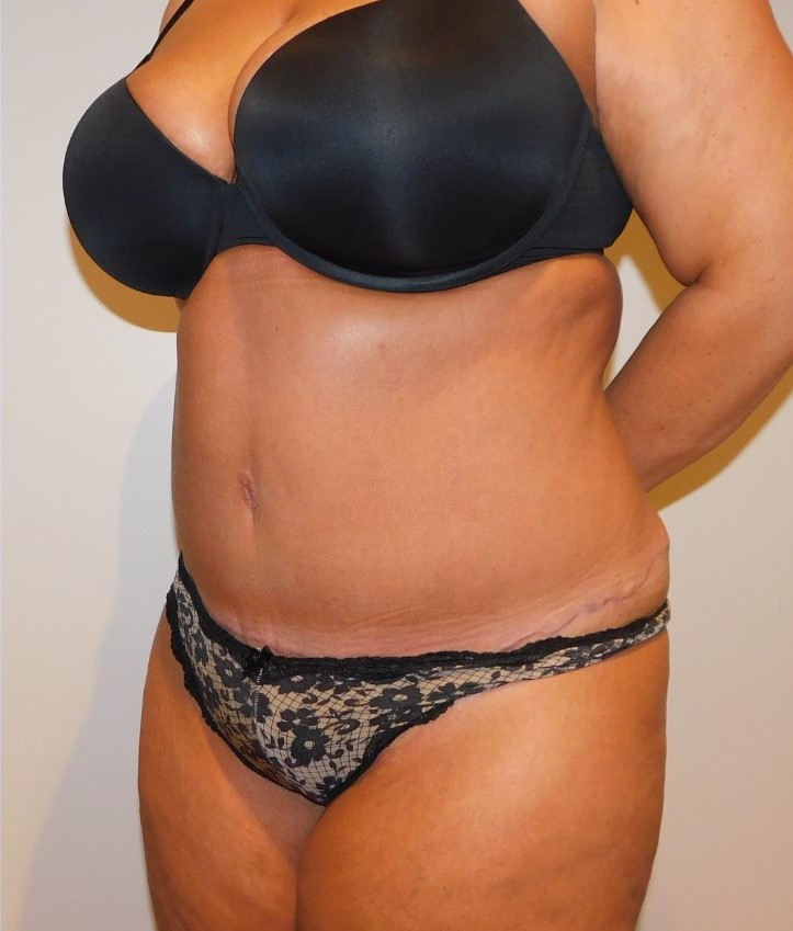 After Image: Tummy Tuck - left-front-oblique