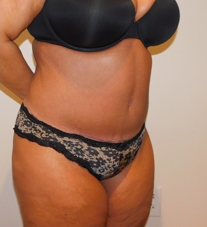 After Image: Tummy Tuck - right-front-oblique