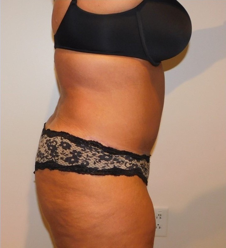 After Image: Tummy Tuck - right-side