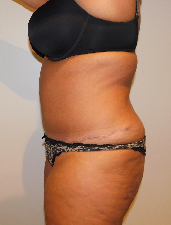 After Image: Tummy Tuck - left-side