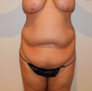 Before Image: Tummy Tuck