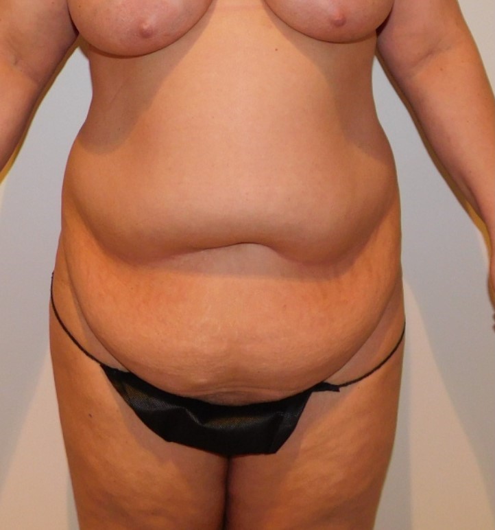 Before Image: Tummy Tuck - front