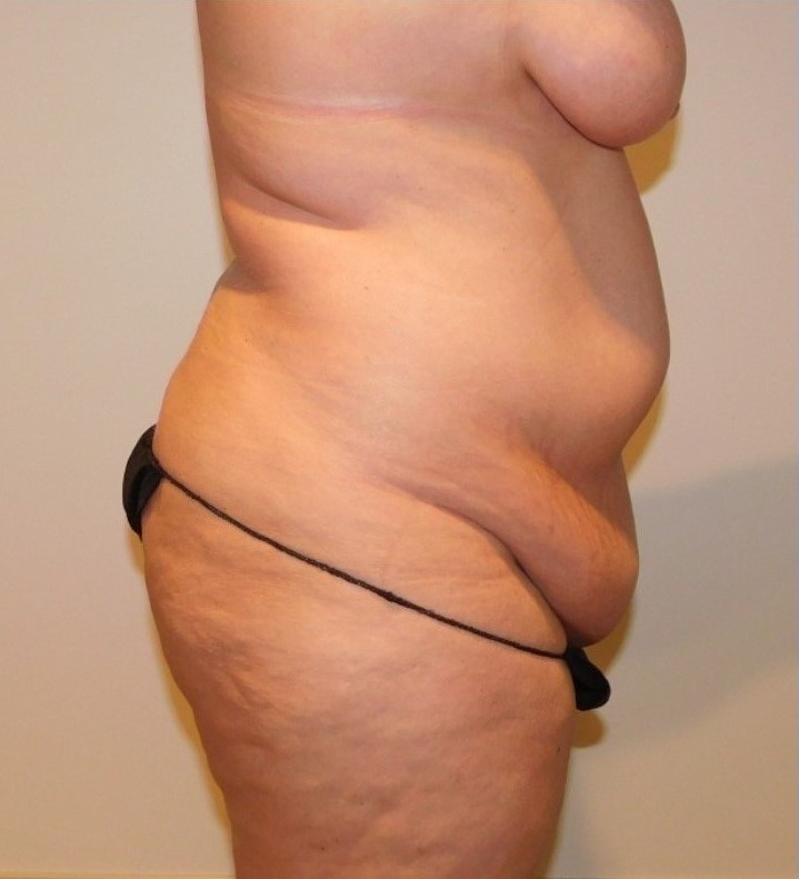 Before Image: Tummy Tuck - right-side