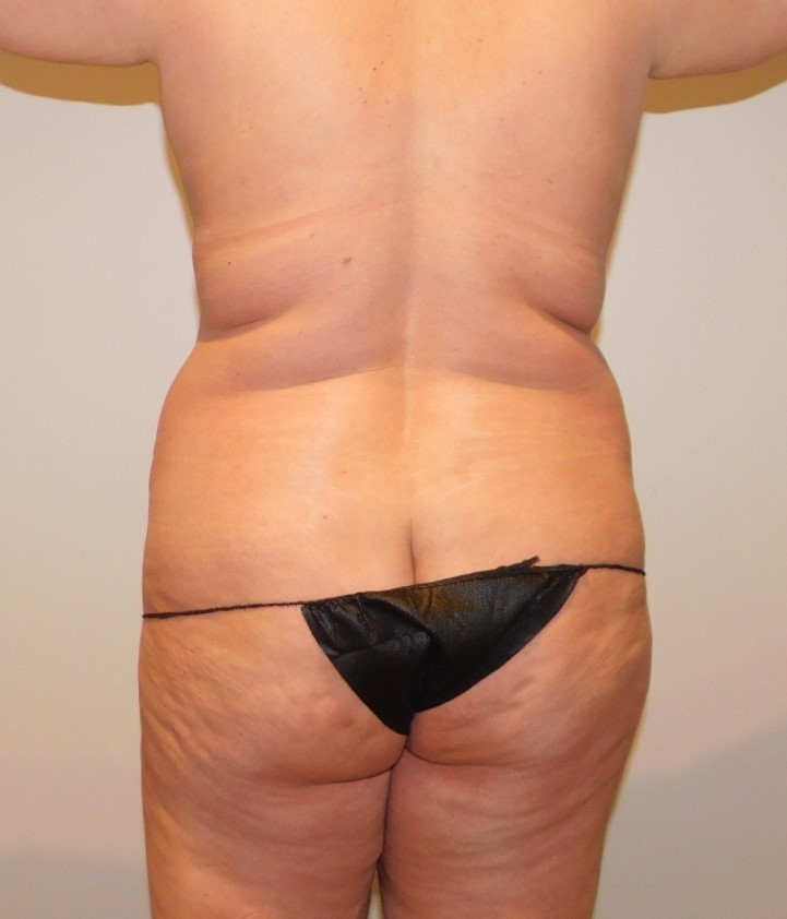 Before Image: Tummy Tuck - back