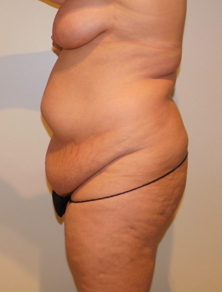 Before Image: Tummy Tuck - left-side