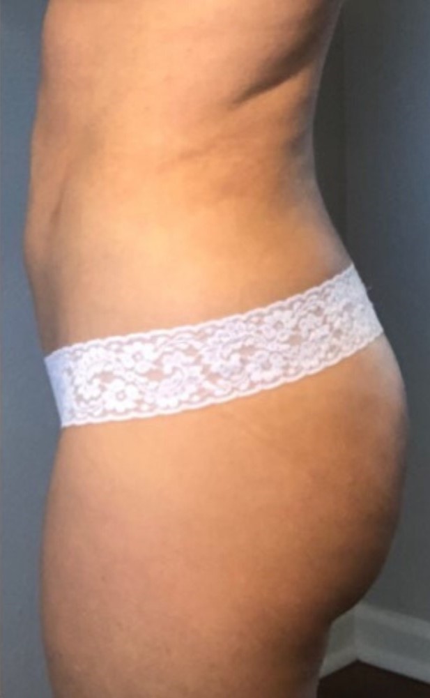 After Image: Standard Liposuction - left-side