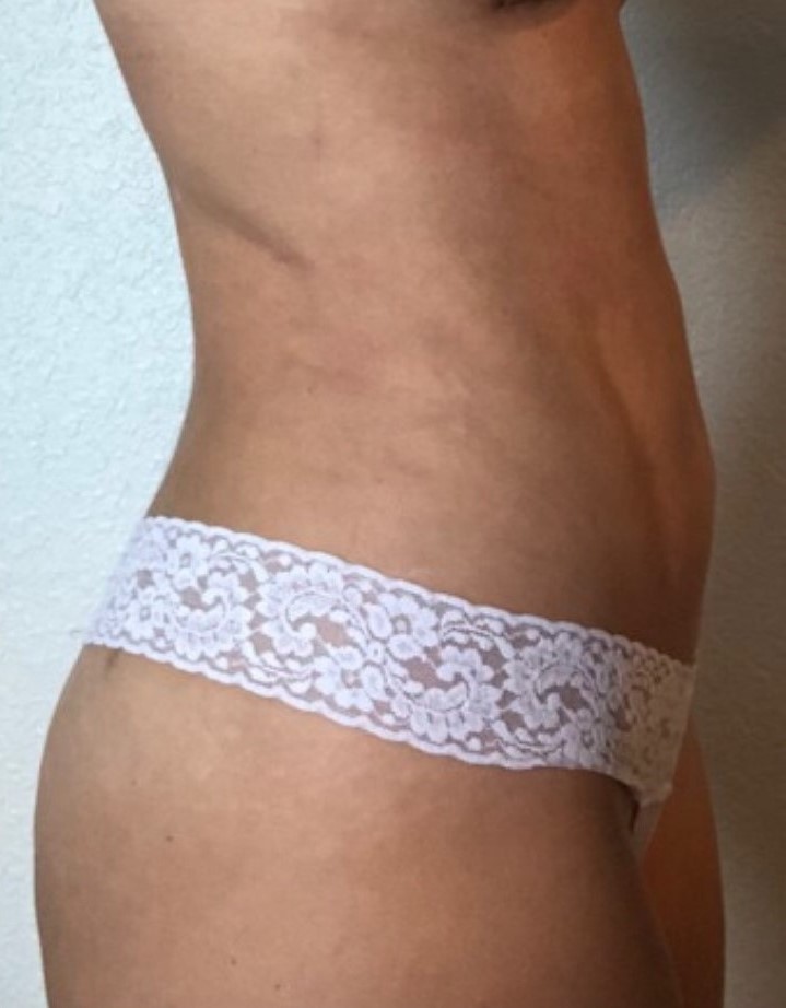 After Image: Standard Liposuction - right-side