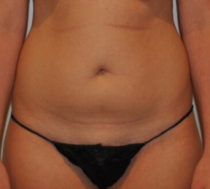 Before Image: Standard Liposuction - front